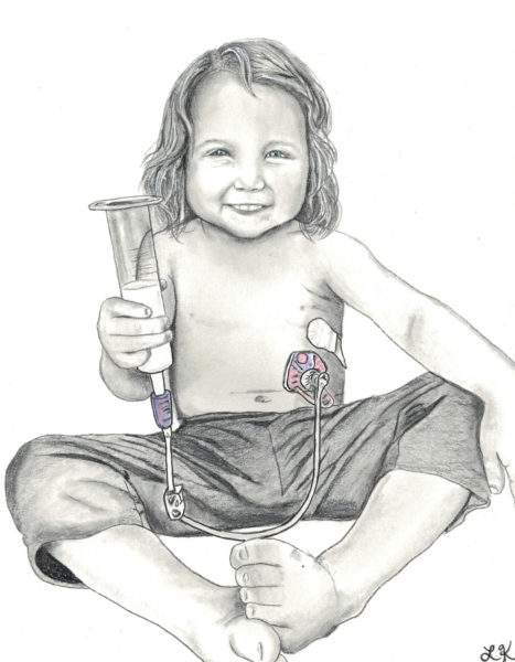 Smiling child with gastrostomy tube